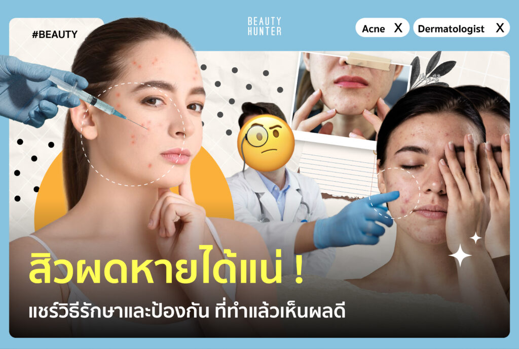 "สิวผด" หายได้แน่! แชร์วิธีรักษาและป้องกัน ที่ทำแล้วเห็นผลดี