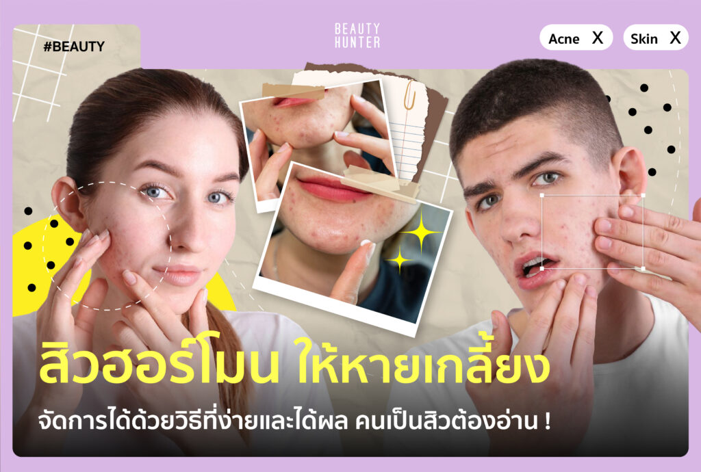 “สิวฮอร์โมน” ให้หายเกลี้ยง จัดการได้ด้วยวิธีที่ง่ายและได้ผล คนเป็นสิวต้องอ่าน ! "สิวฮอร์โมน" ให้หายเกลี้ยง จัดการได้ด้วยวิธีที่ง่ายและได้ผล คนเป็นสิวต้องอ่าน !